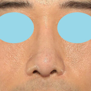 「鼻中隔延長＋耳介軟骨移植＋鼻尖形成＋鼻柱下降＋猫手術＋真皮脂肪移植（鼻尖）＋鼻プロテーゼ隆鼻術」　新宿ラクル美容外科クリニック　２０代女性　手術後１ヶ月目　１０月２２日