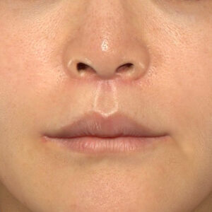 新宿ラクル美容外科クリニック　山本厚志　「人中短縮術（リップリフト）＋口角挙上（スマイルリップ）」　手術後１ヶ月目　１０月２８日
