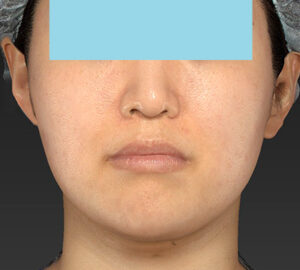 新宿ラクル美容外科クリニック　山本厚志　「ライポライフ脂肪吸引（メーラーファット）＋貴族手術」　手術後１ヶ月目　１０月１０日