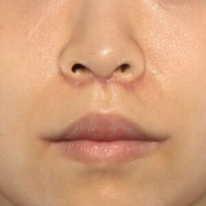 新宿ラクル美容外科クリニック　山本厚志　「人中短縮術（リップリフト）＋口角挙上（スマイルリップ）」　手術後１ヶ月目　１０月１３日