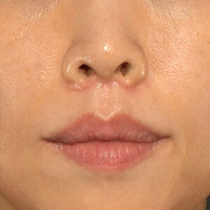 新宿ラクル美容外科クリニック　山本厚志　「人中短縮術（リップリフト）」　手術後１ヶ月目　１０月１４日
