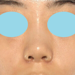 「小鼻縮小+α＋鼻尖縮小（close法）」　新宿ラクル美容外科クリニック　２０代女性　手術後１ヶ月目　１０月１５日