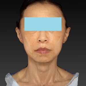 新宿ラクル美容外科クリニック　山本厚志　ナチュラルフェイスネックリフト　手術後２ヶ月目　１０月２５日