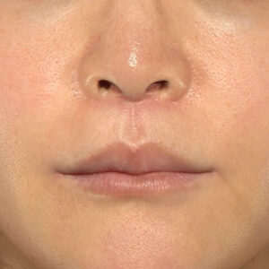 新宿ラクル美容外科クリニック　山本厚志　「人中短縮術（リップリフト）＋口角挙上（スマイルリップ）」　手術後２ヶ月目　１０月２８日