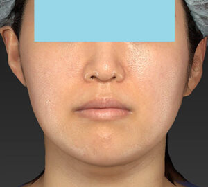 新宿ラクル美容外科クリニック　山本厚志　「ライポライフ脂肪吸引（メーラーファット）＋貴族手術」　手術後２ヶ月目　１０月１０日