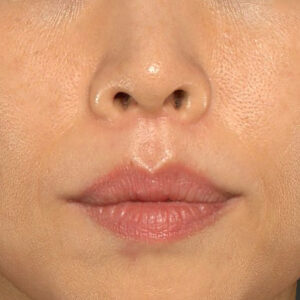新宿ラクル美容外科クリニック　山本厚志　「人中短縮術（リップリフト）」　手術後２ヶ月目　１０月１４日