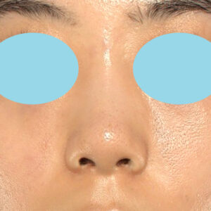 「小鼻縮小+α＋鼻尖縮小（close法）」　新宿ラクル美容外科クリニック　２０代女性　手術後２ヶ月目　１０月１５日