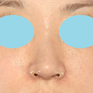 「耳介軟骨移植＋鼻尖縮小（close法）＋小鼻縮小+α＋貴族手術」　新宿ラクル美容外科クリニック　３０代女性　手術後２ヶ月目　１０月２１日