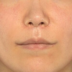 新宿ラクル美容外科クリニック　山本厚志　「人中短縮術（リップリフト）＋口角挙上（スマイルリップ）」　手術後３ヶ月目　１０月１１日