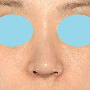 「耳介軟骨移植＋鼻尖縮小（close法）＋小鼻縮小+α＋貴族手術」　新宿ラクル美容外科クリニック　３０代女性　手術後３ヶ月目　１１月１９日