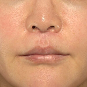 新宿ラクル美容外科クリニック　山本厚志　「人中短縮術（リップリフト）＋口角挙上（スマイルリップ）」　手術後３ヶ月目　１１月２４日