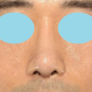 「鼻中隔延長＋耳介軟骨移植＋鼻尖形成＋鼻柱下降＋猫手術＋真皮脂肪移植（鼻尖）＋鼻プロテーゼ隆鼻術」　新宿ラクル美容外科クリニック　２０代女性　手術後３ヶ月目　１１月２６日