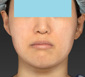 新宿ラクル美容外科クリニック　山本厚志　「ライポライフ脂肪吸引（メーラーファット）＋貴族手術」　手術後３ヶ月目　１０月１０日