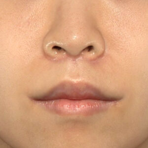 新宿ラクル美容外科クリニック　山本厚志　「人中短縮術（リップリフト）＋口角挙上（スマイルリップ）」　手術後３ヶ月目　１０月１３日