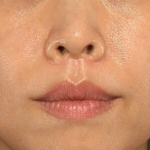 新宿ラクル美容外科クリニック　山本厚志　「人中短縮術（リップリフト）」　手術後３ヶ月目　１１月１１日
