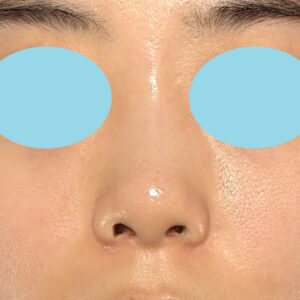 「小鼻縮小+α＋鼻尖縮小（close法）」　新宿ラクル美容外科クリニック　２０代女性　手術後３ヶ月目　１１月１６日