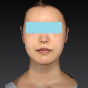 新宿ラクル美容外科クリニック　山本厚志　ナチュラルフェイスリフト　手術後６ヶ月目　１０月４日