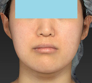 新宿ラクル美容外科クリニック　山本厚志　「ライポライフ脂肪吸引（メーラーファット）＋貴族手術」　手術後６ヶ月目　１２月１９日