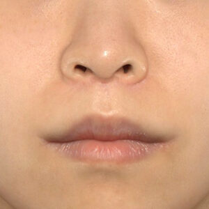 新宿ラクル美容外科クリニック　山本厚志　「人中短縮術（リップリフト）＋口角挙上（スマイルリップ）」　手術後６ヶ月目　１月１５日