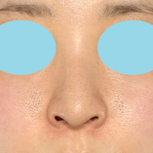 新宿ラクル美容外科クリニック　山本厚志　「貴族手術（鼻翼基部プロテーゼ）＋ 小鼻縮小+α法」　手術後６ヶ月目　３月１５日