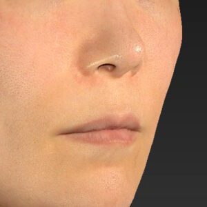 新宿ラクル美容外科クリニック　山本厚志　「人中短縮術（リップリフト）＋口角挙上（スマイルリップ）」　手術前　１０月１１日