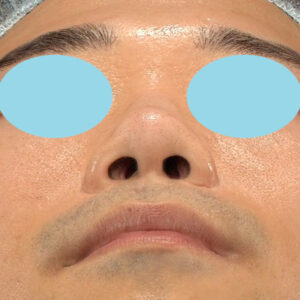 「鼻中隔延長＋耳介軟骨移植＋鼻尖形成＋鼻柱下降＋猫手術＋真皮脂肪移植（鼻尖）＋鼻プロテーゼ隆鼻術」　新宿ラクル美容外科クリニック　２０代女性　手術前　１０月２２日