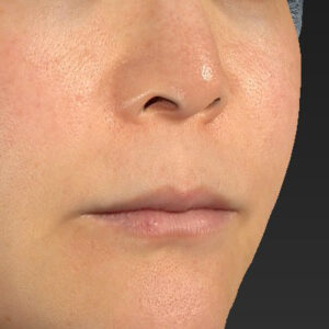 新宿ラクル美容外科クリニック　山本厚志　「人中短縮術（リップリフト）＋口角挙上（スマイルリップ）」　手術前　１０月２８日