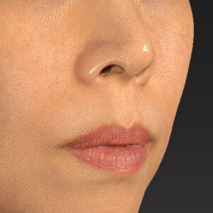 新宿ラクル美容外科クリニック　山本厚志　「人中短縮術（リップリフト）」　手術前　１０月１４日