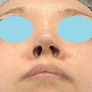 「耳介軟骨移植＋鼻尖縮小（close法）＋小鼻縮小+α＋貴族手術」　新宿ラクル美容外科クリニック　３０代女性　手術前　１０月２１日