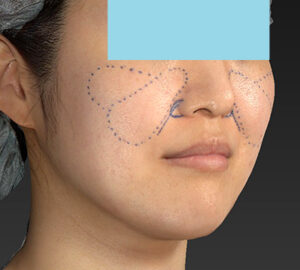 新宿ラクル美容外科クリニック　山本厚志　「ライポライフ脂肪吸引（メーラーファット）＋貴族手術」　デザイン　１０月１０日