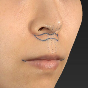 新宿ラクル美容外科クリニック　山本厚志　「人中短縮術（リップリフト）＋口角挙上（スマイルリップ）」　デザイン　１０月１３日