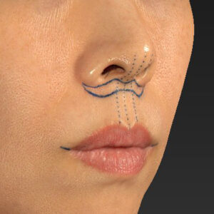 新宿ラクル美容外科クリニック　山本厚志　「人中短縮術（リップリフト）」　デザイン　１０月１４日