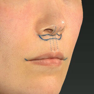 新宿ラクル美容外科クリニック　山本厚志　「人中短縮術（リップリフト）＋口角挙上（スマイルリップ）」　デザイン　１０月１１日