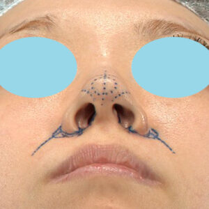 「耳介軟骨移植＋鼻尖縮小（close法）＋小鼻縮小+α＋貴族手術」　新宿ラクル美容外科クリニック　３０代女性　デザイン　１０月２１日