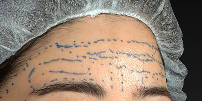 デザイン 新宿ラクル美容外科クリニック 山本厚志 「額の若返り(ジュビダームビスタ・ボリューマXC)」 デザイン 10月23日