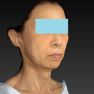 新宿ラクル美容外科クリニック　山本厚志　ナチュラルフェイスネックリフト　デザイン　１０月２５日