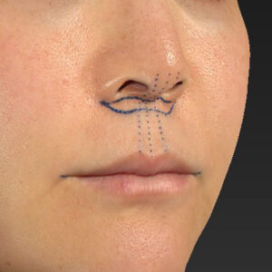 新宿ラクル美容外科クリニック　山本厚志　「人中短縮術（リップリフト）＋口角挙上（スマイルリップ）」　デザイン　１０月２８日