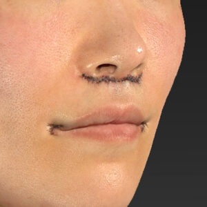 新宿ラクル美容外科クリニック　山本厚志　「人中短縮術（リップリフト）＋口角挙上（スマイルリップ）」　手術直後　１０月１１日