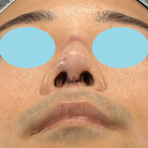 「鼻中隔延長＋耳介軟骨移植＋鼻尖形成＋鼻柱下降＋猫手術＋真皮脂肪移植（鼻尖）＋鼻プロテーゼ隆鼻術」　新宿ラクル美容外科クリニック　２０代女性　手術直後　１０月２２日