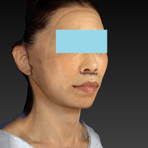 新宿ラクル美容外科クリニック　山本厚志　ナチュラルフェイスネックリフト　手術直後　１０月２５日