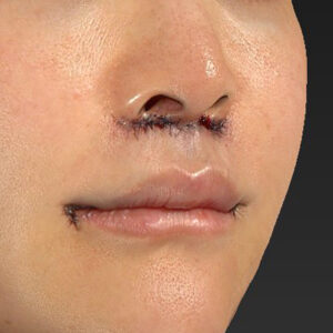 新宿ラクル美容外科クリニック　山本厚志　「人中短縮術（リップリフト）＋口角挙上（スマイルリップ）」　手術直後　１０月２８日