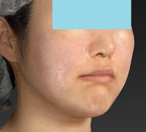 新宿ラクル美容外科クリニック　山本厚志　「ライポライフ脂肪吸引（メーラーファット）＋貴族手術」　手術直後　１０月１０日