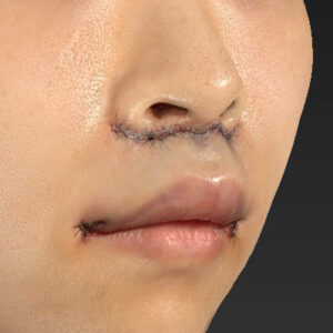 新宿ラクル美容外科クリニック　山本厚志　「人中短縮術（リップリフト）＋口角挙上（スマイルリップ）」　手術直後　１０月１３日