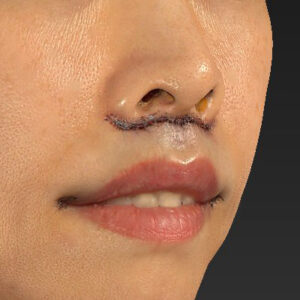 新宿ラクル美容外科クリニック　山本厚志　「人中短縮術（リップリフト）」　手術直後　１０月１４日