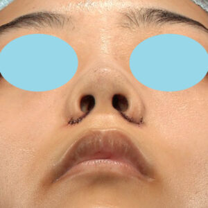 「小鼻縮小+α＋鼻尖縮小（close法）」　新宿ラクル美容外科クリニック　２０代女性　手術直後　１０月１５日