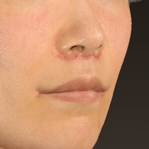 新宿ラクル美容外科クリニック　山本厚志　「人中短縮術（リップリフト）＋口角挙上（スマイルリップ）」　手術後１週間目　１０月１１日