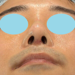 「鼻中隔延長＋耳介軟骨移植＋鼻尖形成＋鼻柱下降＋猫手術＋真皮脂肪移植（鼻尖）＋鼻プロテーゼ隆鼻術」　新宿ラクル美容外科クリニック　２０代女性　手術後１週間目　１０月２２日