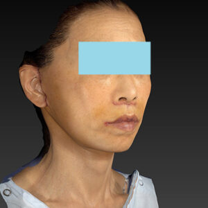 新宿ラクル美容外科クリニック　山本厚志　ナチュラルフェイスネックリフト　手術後１週間目　１０月２５日