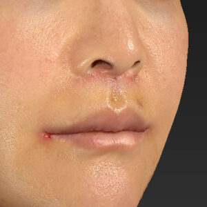 新宿ラクル美容外科クリニック　山本厚志　「人中短縮術（リップリフト）＋口角挙上（スマイルリップ）」　手術後１週間目　１０月２８日