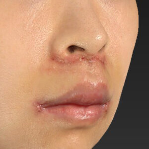 新宿ラクル美容外科クリニック　山本厚志　「人中短縮術（リップリフト）＋口角挙上（スマイルリップ）」　手術後１週間目　１０月１３日